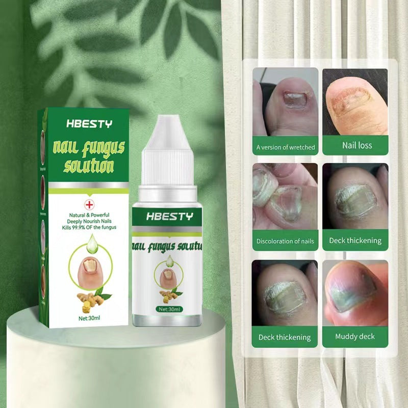 Nail Fungal Treatment